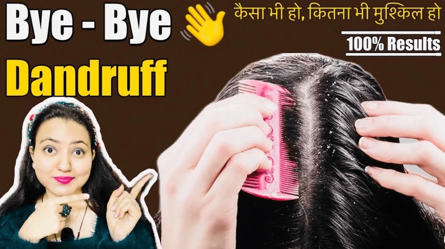 You are currently viewing How To Treat Dandruff At Home | Preity Prerna