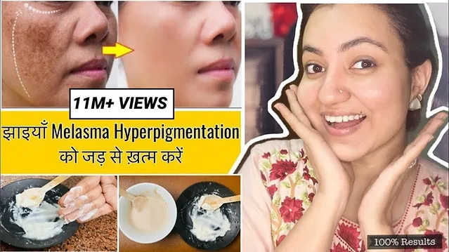 You are currently viewing Hyperpigmentation Treatment