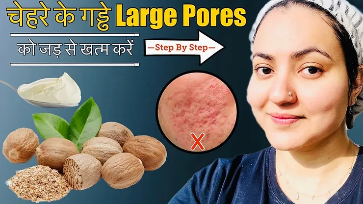 Read more about the article Acne Scars, Open Pores, Large Pores & Dark Spots | Preity Prerna