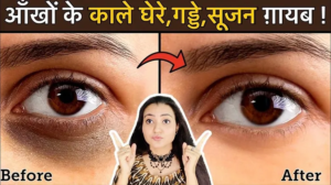 Read more about the article How To Cure Dark Circles, Puffy and Sunken Eyes Naturally?