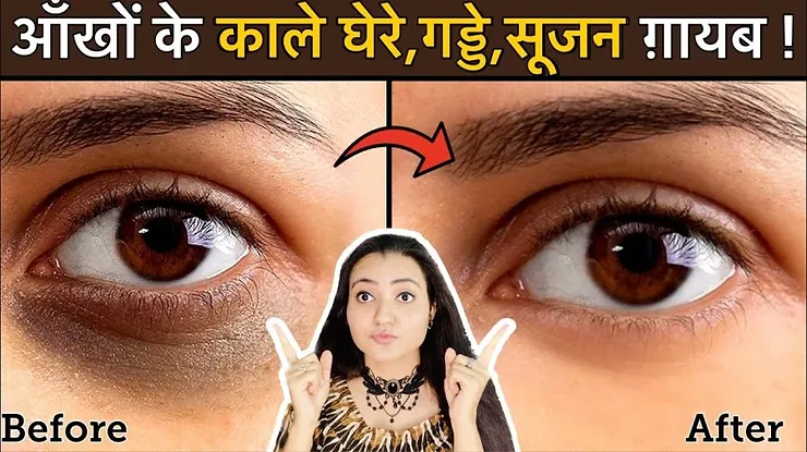 Read more about the article How To Cure Dark Circles, Puffy and Sunken Eyes Naturally?