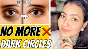 Read more about the article How To Remove Dark Circles Permanently At Home?