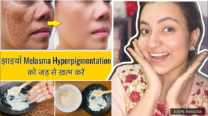 Read more about the article How To Treat Hyperpigmentation At Home Naturally?