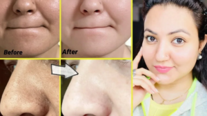 Read more about the article How To Remove Blackheads And Whiteheads At Home Naturally?